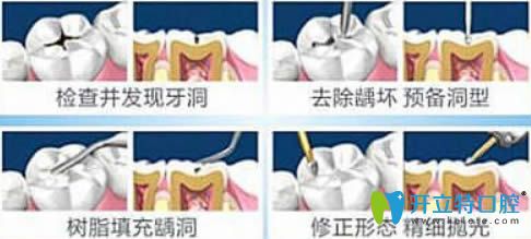 開立特口腔網(wǎng)兒童補(bǔ)牙過程圖解