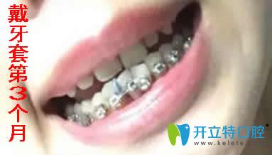 我在寧波拜博拜爾口腔做金屬自鎖托槽矯正第3個月照片