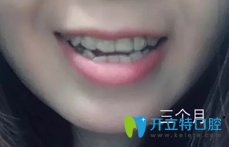 牙齒過度擁擠在深圳鵬程口腔戴隱形牙套3個(gè)月時(shí)候照片