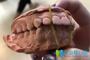 圍觀我花5萬多讓廈門賽德陽光洪慈憶做的齙牙矯正怎么樣？