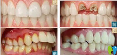 重慶眾植博仕口腔種植牙及牙齒矯正案例效果圖