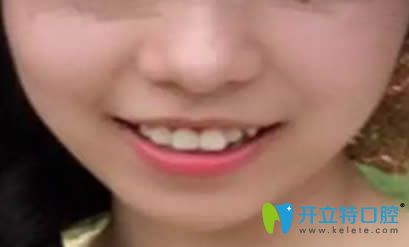 佩戴正雅隱形牙套3個月留照