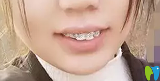 牙齒矯正3個月照片