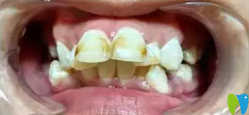 在拉斐爾口腔做矯正前照片