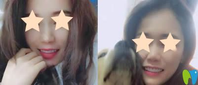 重慶眾植博仕口腔超薄牙貼面術后一月照