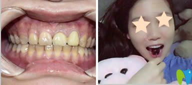 重慶眾植博仕口腔超薄瓷貼面效果對比圖