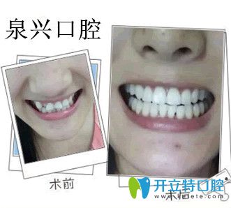 泉興口腔惠雯婷隱形矯正對(duì)比圖