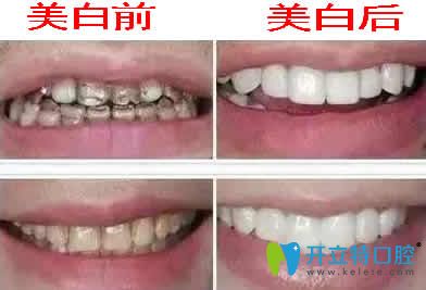四環(huán)素牙美白前后對比圖