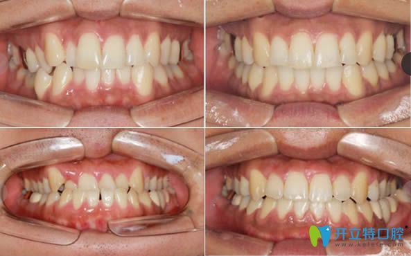 <!--<i data=20240703-sp></i>-->口腔牙齒擁擠和地包矯正前后對比圖