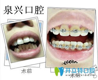 我在泉興口腔找惠雯婷院長(zhǎng)做完牙齒矯正效果圖