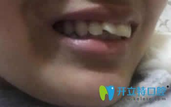 我在濰坊可恩口腔做隱形牙齒矯正1年后成功和齙牙說(shuō)拜拜