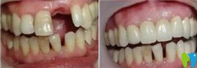 重慶眾植博仕口腔張延昭種植牙效果對(duì)比圖