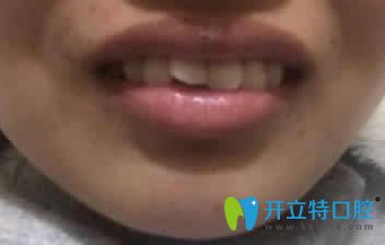 我在濰坊可恩口腔做隱形牙齒矯正第3個月照片