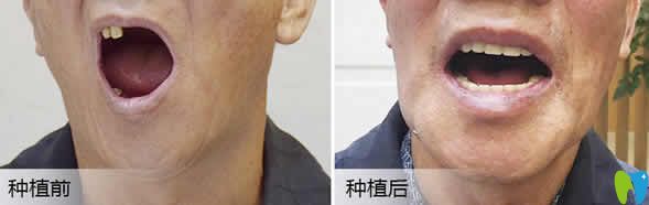 武漢優(yōu)益佳口腔楊丕波種植牙案例效果圖 武漢優(yōu)益佳口腔楊丕波種植牙案例效果圖