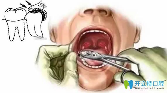 拔智齒后有個(gè)洞怎么辦？請(qǐng)看拔智齒牙洞窟窿恢復(fù)過(guò)程圖