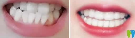 武漢優(yōu)益佳口腔陶麗萍隱形牙齒矯正案例效果圖 武漢優(yōu)益佳口腔陶麗萍隱形牙齒矯正案例效果圖