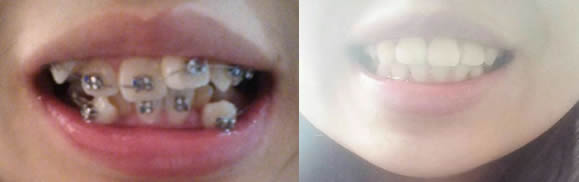 分享高中畢業(yè)后在泉興口腔做牙齒矯正經(jīng)歷，共花費(fèi)12000元