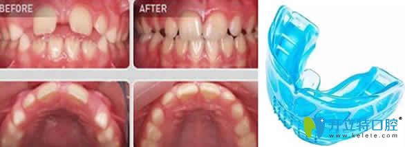 武漢優(yōu)益佳口腔邱楚宸兒童肌功能矯正效果圖 武漢優(yōu)益佳口腔邱楚宸兒童肌功能矯正效果圖