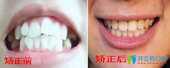 武漢優(yōu)益佳口腔楊<!--<i data=20240703-sp></i>-->隱形牙齒矯正案例圖 武漢優(yōu)益佳口腔楊<!--<i data=20240703-sp></i>-->隱形牙齒矯正案例圖