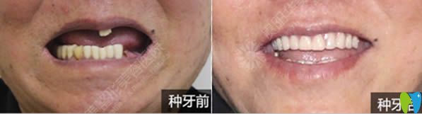 半口牙缺失種植案例及對比照 半口牙缺失種植案例及對比照