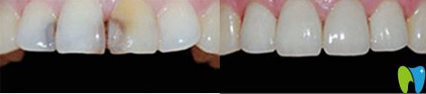 <!--<i data=20240703-sp></i>-->濤真人牙齒修復(fù)案例