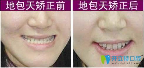 貴陽華美口腔李森醫(yī)生地包天矯正案例及前后對(duì)比照