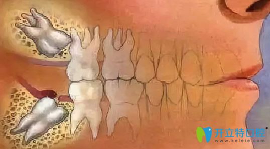 智齒不能正常萌出在正畸中是需要拔掉的