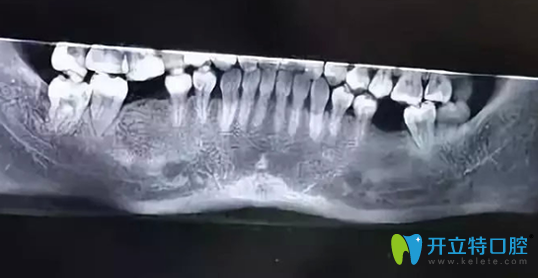 矯正牙齒智齒可以不拔的情況