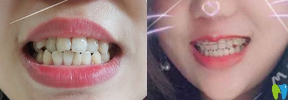 在北京溪美康口腔做牙齒矯正后對比 在北京溪美康口腔做牙齒矯正后對比