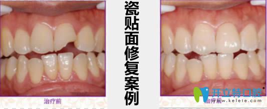 瓷貼面修復(fù)案例及前后對比效果 瓷貼面修復(fù)案例及前后對比效果