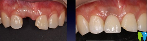 石磊單顆牙種植真人案例 石磊單顆牙種植真人案例