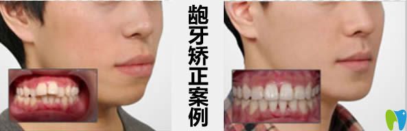 貴陽華美口腔齙牙矯正臉型變化圖