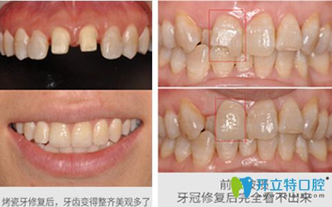 深圳河山齒科趙思詩怎么樣？來看牙齒修復(fù)案例前后效果對(duì)比圖