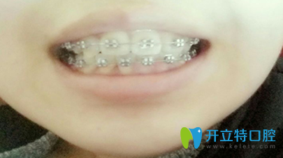 惠院長(zhǎng)矯正后第13個(gè)月變化圖