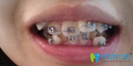 牙齒矯正前的照片