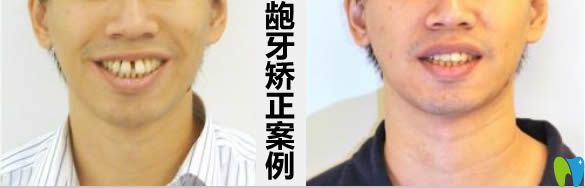 齙牙矯正案例及前后對比效果