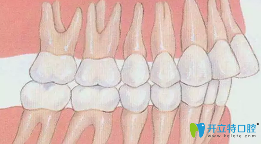本身需要拔牙矯正需要拔掉智齒的情況
