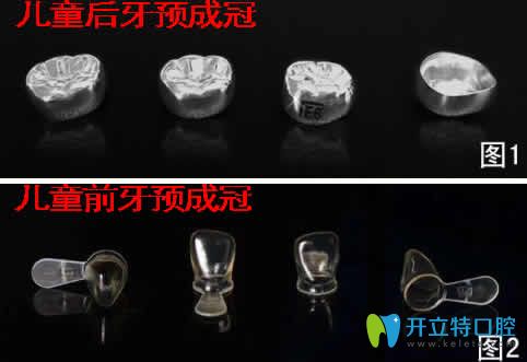 兒童預(yù)成冠對牙齒有沒有危害及戴預(yù)成冠后注意事項的詳解