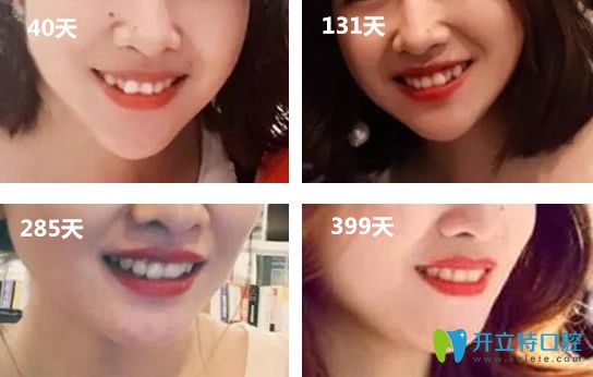 淄博可恩口腔隱適美矯正599天啦 上圖并給大家說說我的感受