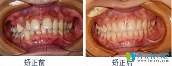 成人牙齒稀疏矯正前后對比效果