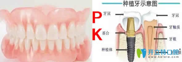 活動(dòng)假牙和種植牙對(duì)比圖