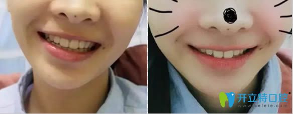 在貴陽華美口腔做完牙齒矯正23個(gè)月后的照片