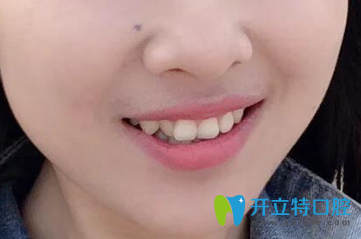 去淄博可恩口腔做戴隱形牙套矯正牙齒前