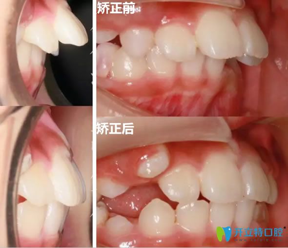 <!--<i data=20240703-sp></i>-->圣貝凌姿兒童深覆蓋矯正案例 <!--<i data=20240703-sp></i>-->圣貝凌姿兒童深覆蓋矯正案例