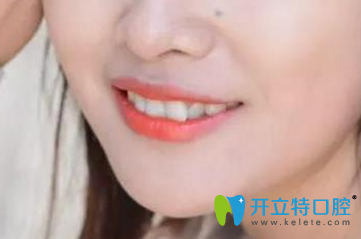 找淄博可恩口腔牟梅做隱適美隱形矯正第1天