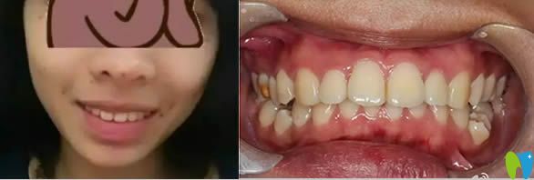 推薦大家去貴陽華美口腔做牙齒矯正 我覺得價格/效果都滿意