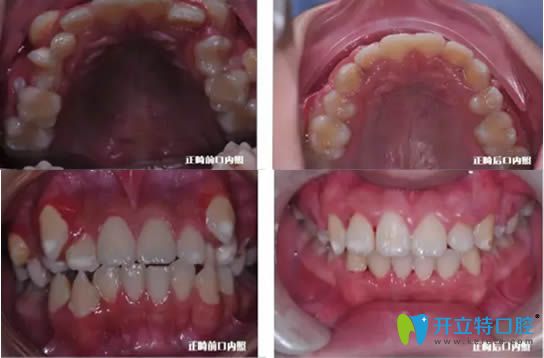 <!--<i data=20240703-sp></i>-->圣貝<!--<i data=20240703-sp></i>-->醫(yī)生兒童牙齒矯正案例及顧客反饋