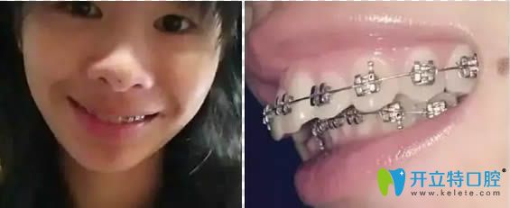 深覆合矯正佩戴牙套中