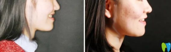 成人地包天矯正后臉型變化圖 成人地包天矯正后臉型變化圖