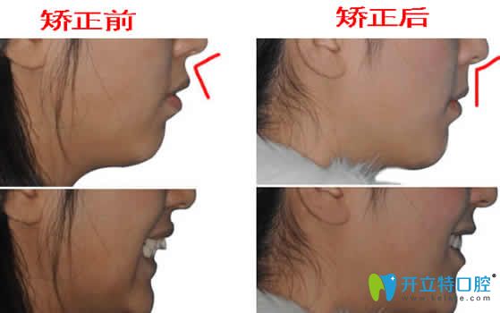 成都德頓齒科隱形牙齒矯正前后對比圖